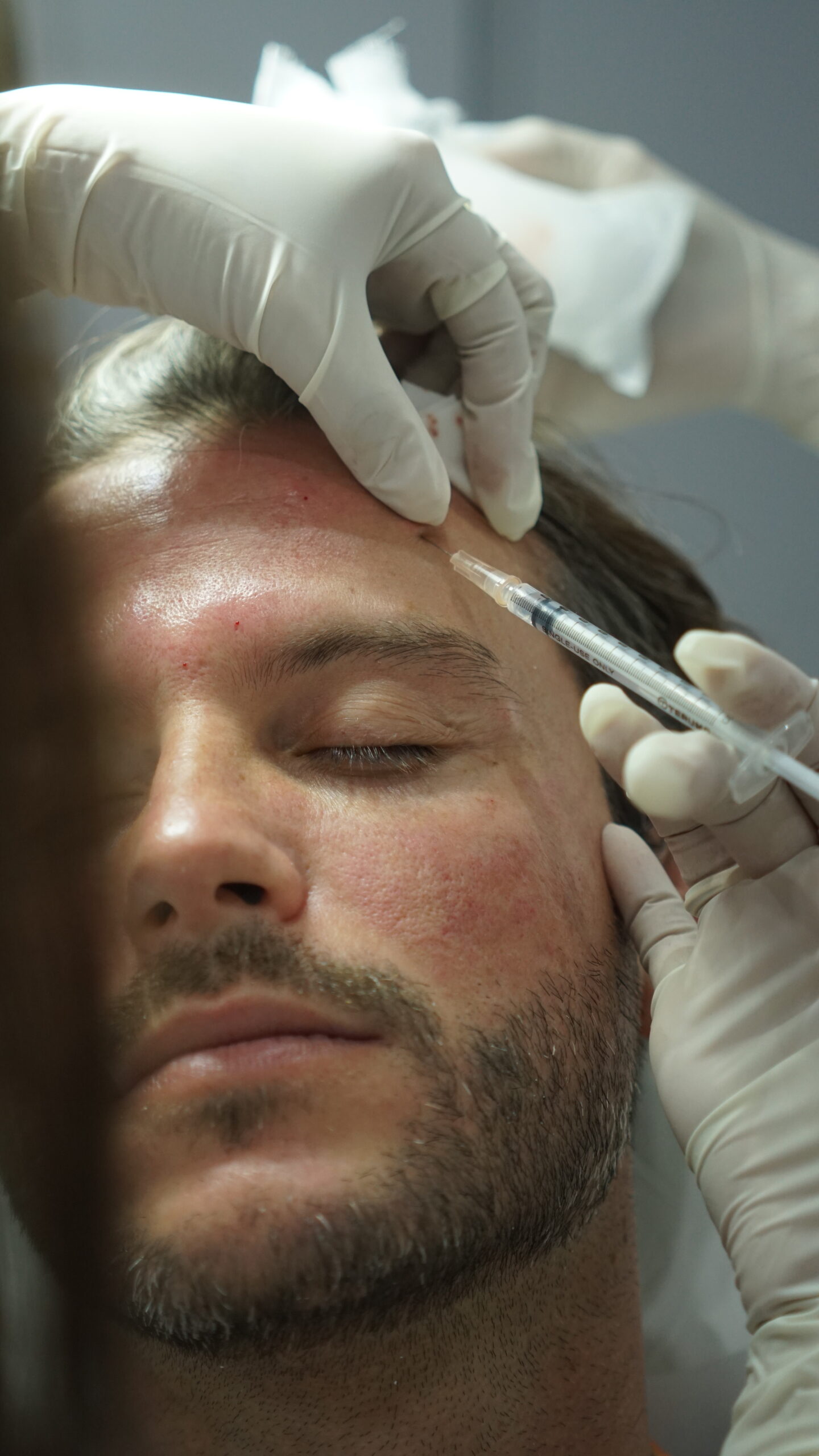 Injectable Rejuvenation Treatments – Body Lab Bali