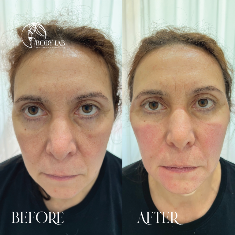 Before After – Body Lab Bali