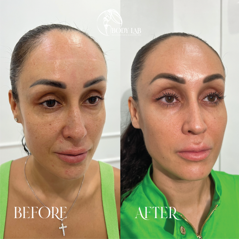 Before After – Body Lab Bali