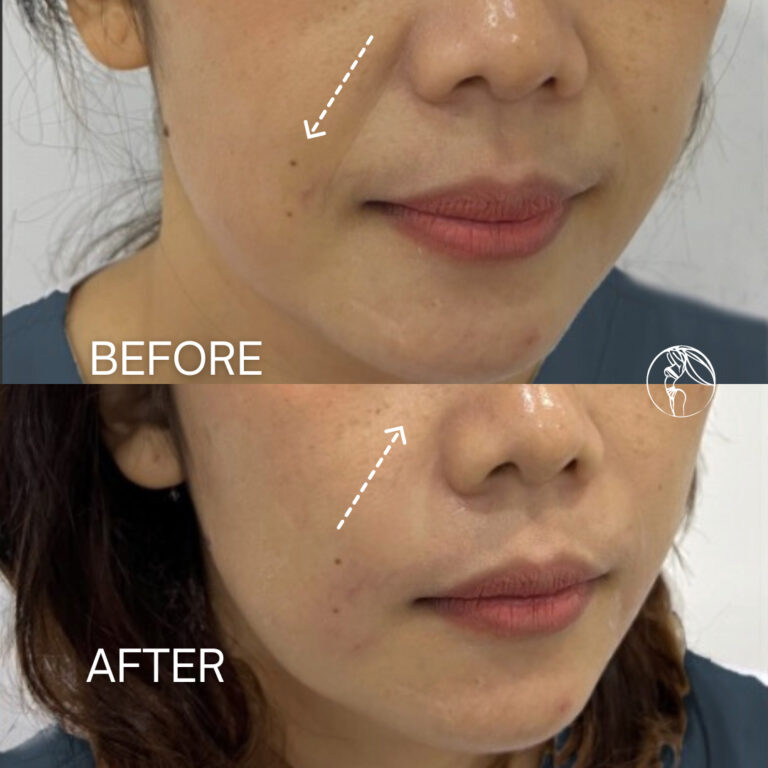 Smile Line Filler