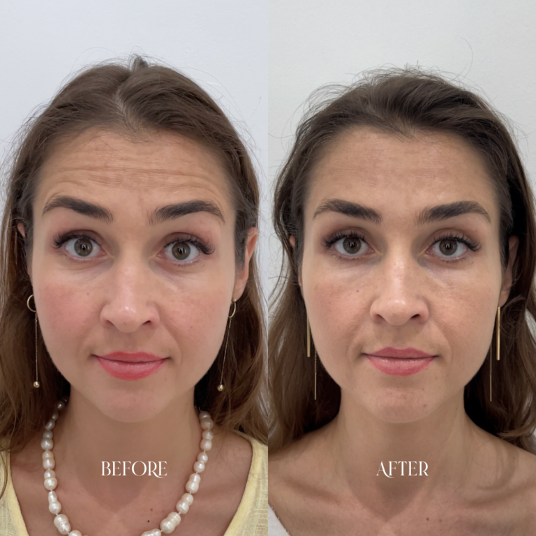Botox