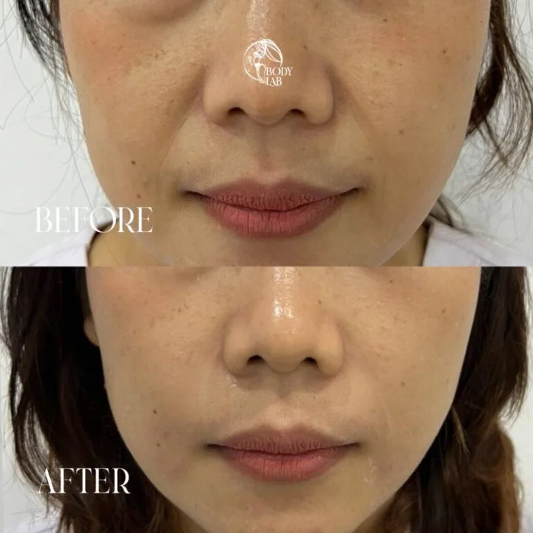 Smile Line Filler