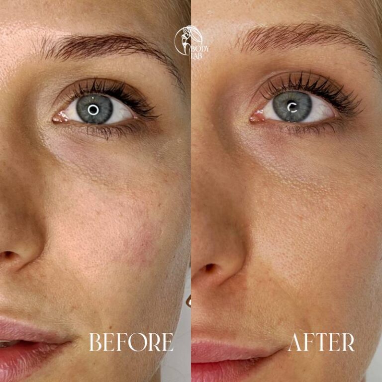 Under Eye Filler