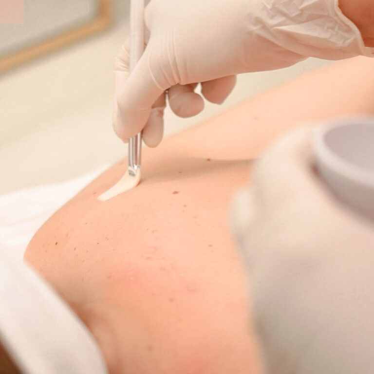 Anti Acne Peel — Body Lab Bali