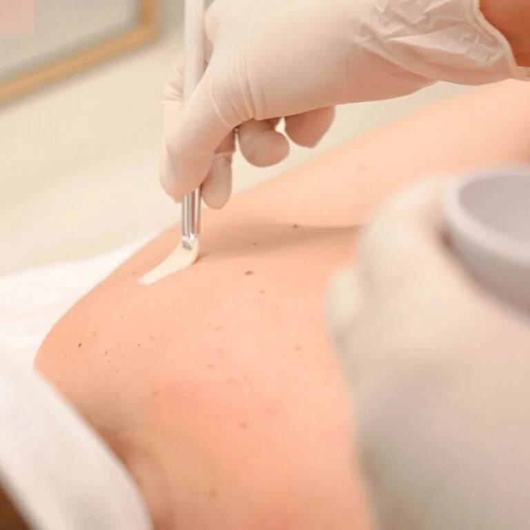 Anti Acne Peel — Body Lab Bali
