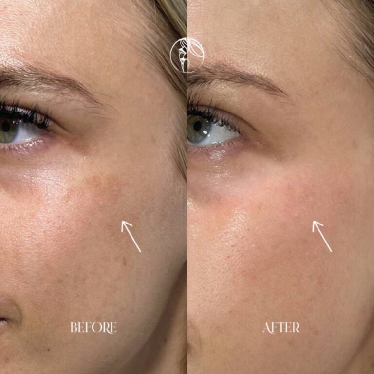 Acid Peeling