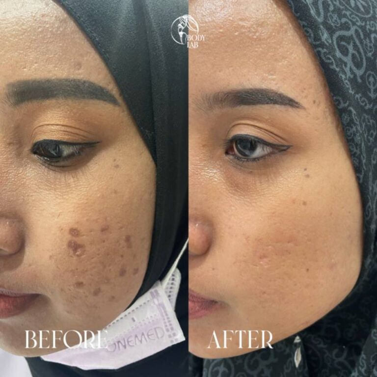 Acid Peeling