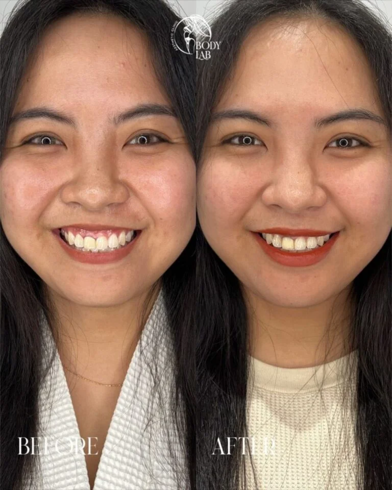 Gummy Smile