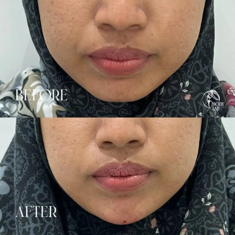 Chin Filler
