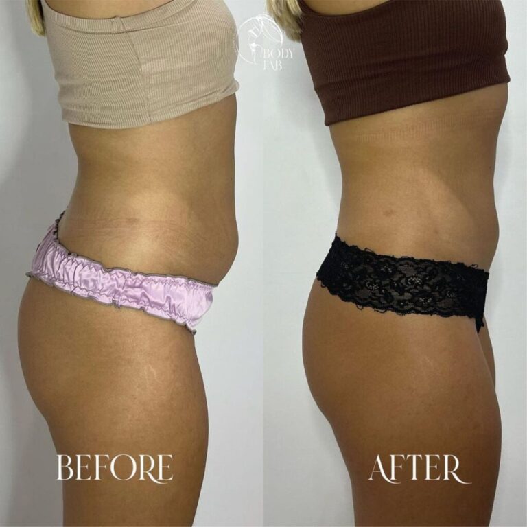Cristal Fat Freezing