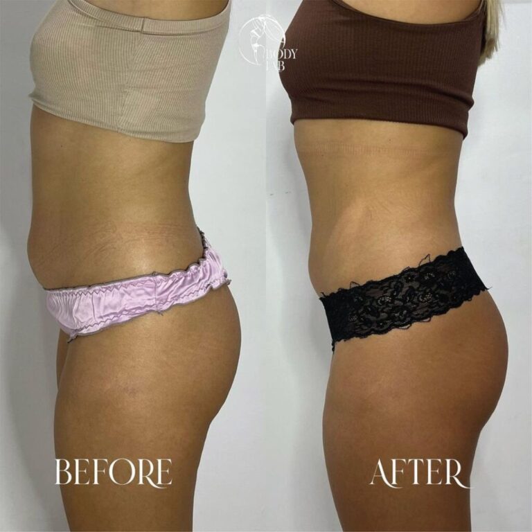 Cristal Fat Freezing