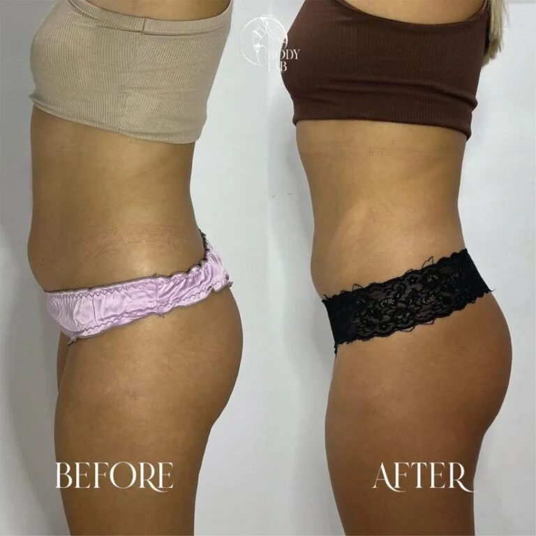 Cristal Fat Freezing