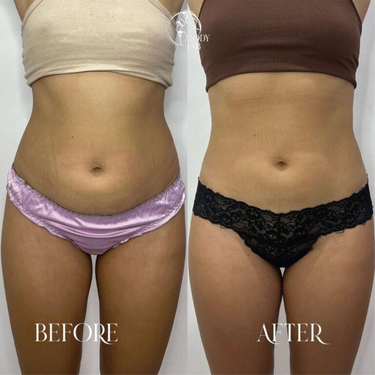 Cristal Fat Freezing