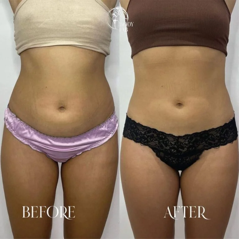 Cristal Fat Freezing