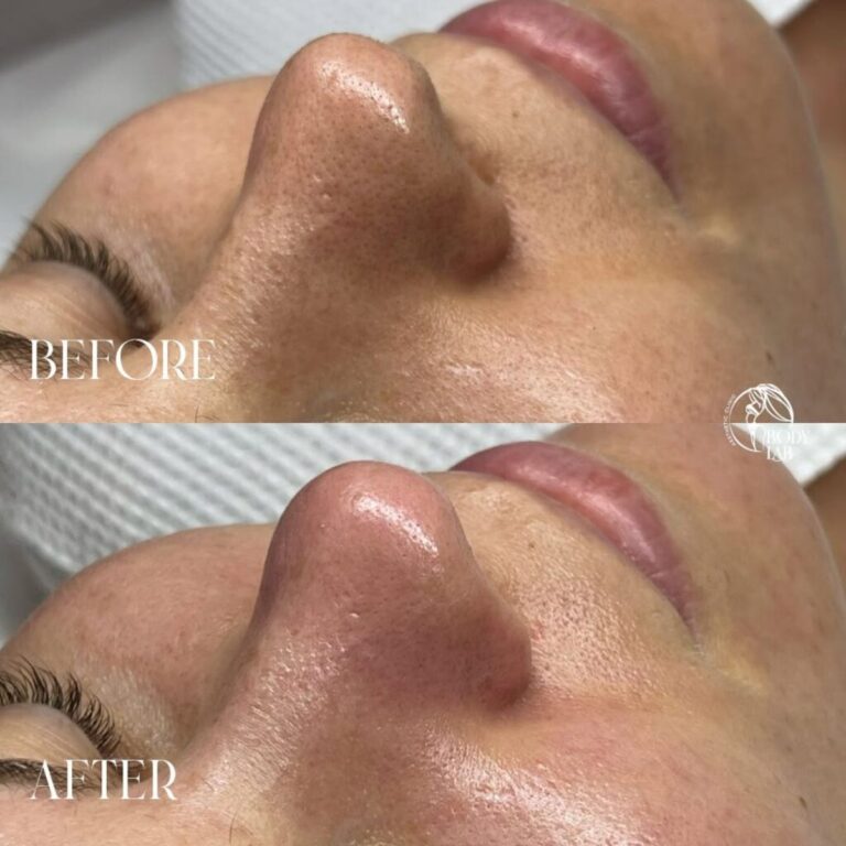 Detox Oxygen Facial