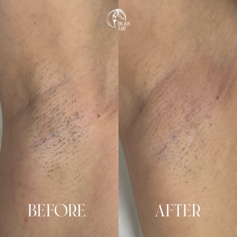 Laser Hair Removal