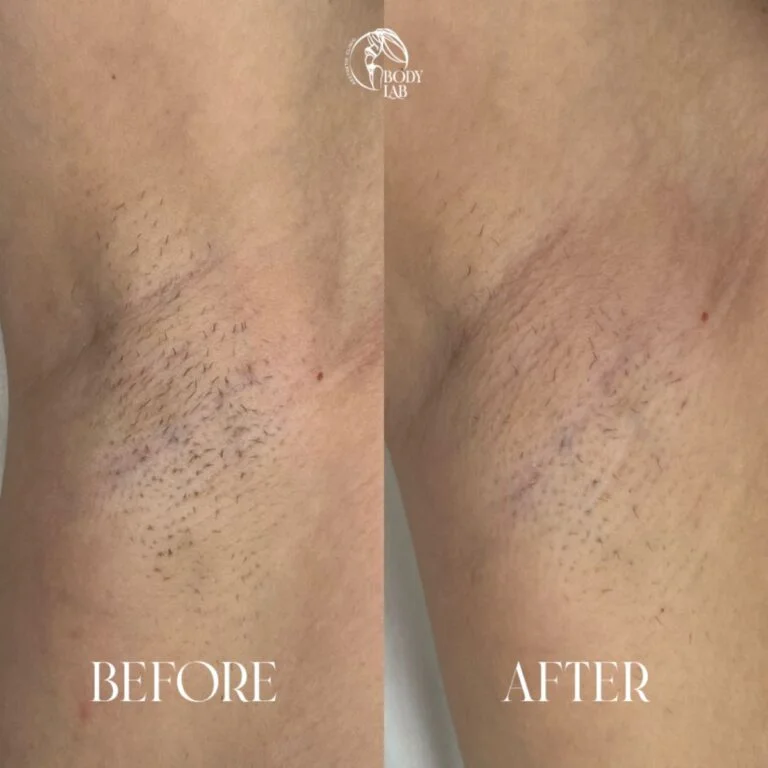 Laser Hair Removal