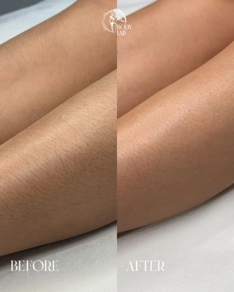 Laser Hair Removal