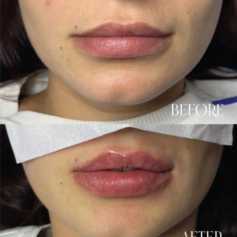 Lip Filler
