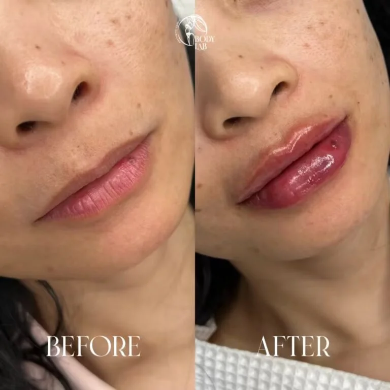 Lip Filler