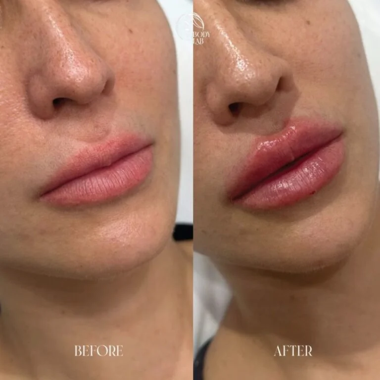 Lip Filler