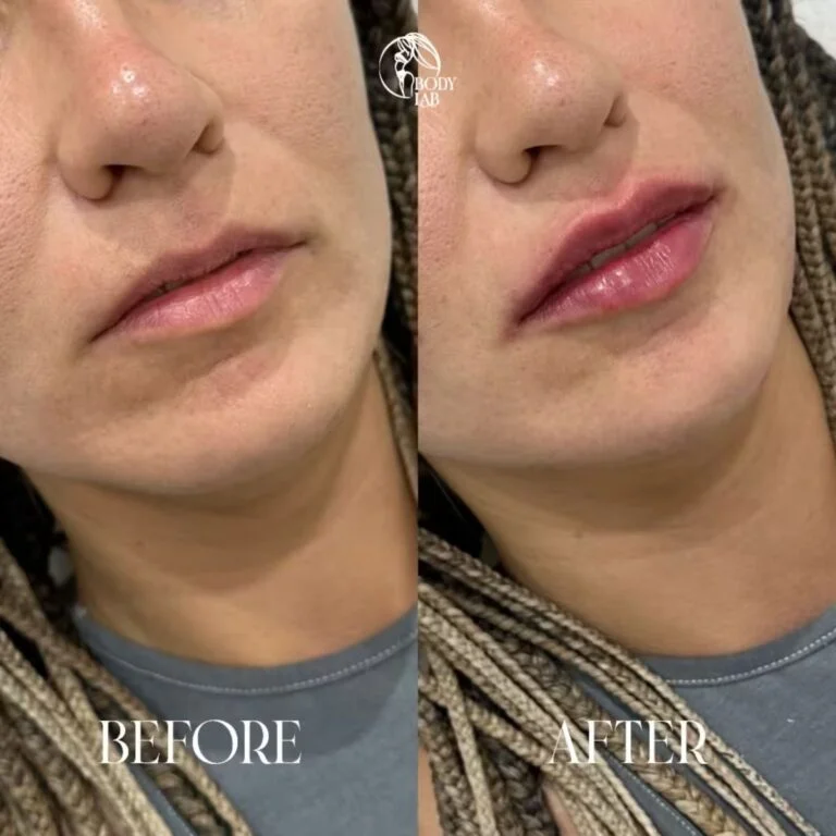 Lip Filler