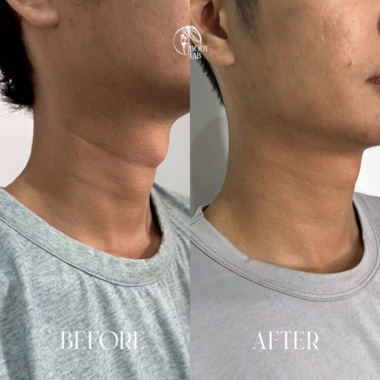 Neck Filler