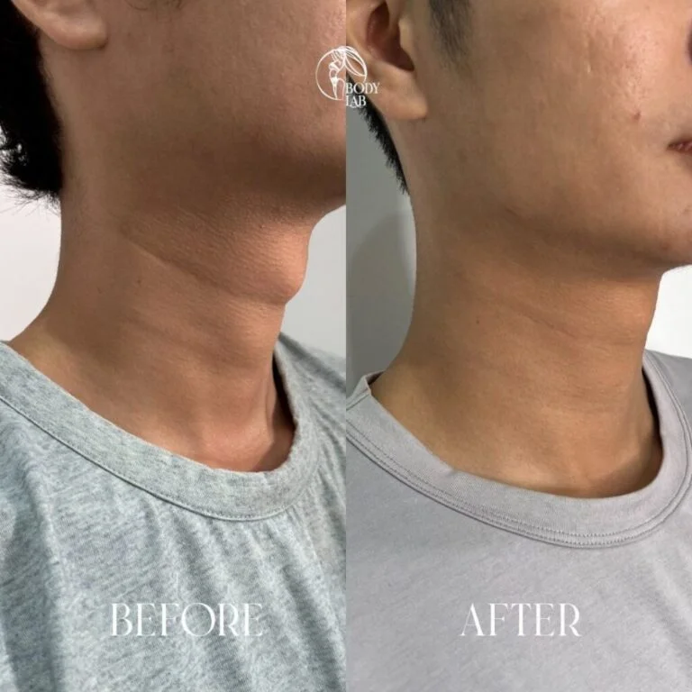 Neck Filler