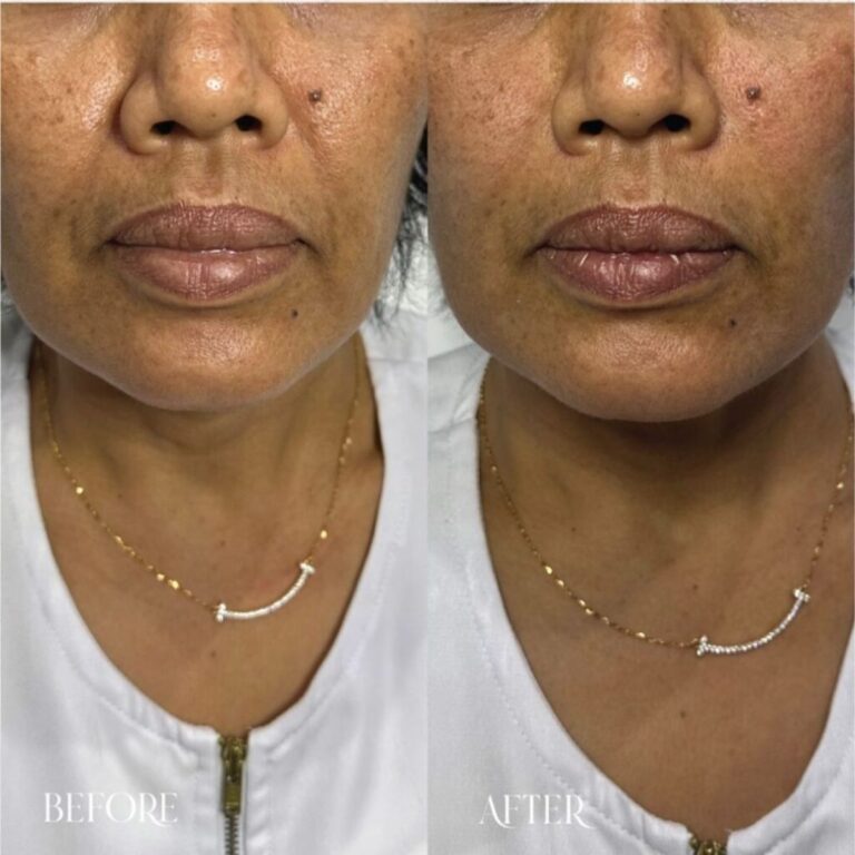 Smile Line Filler