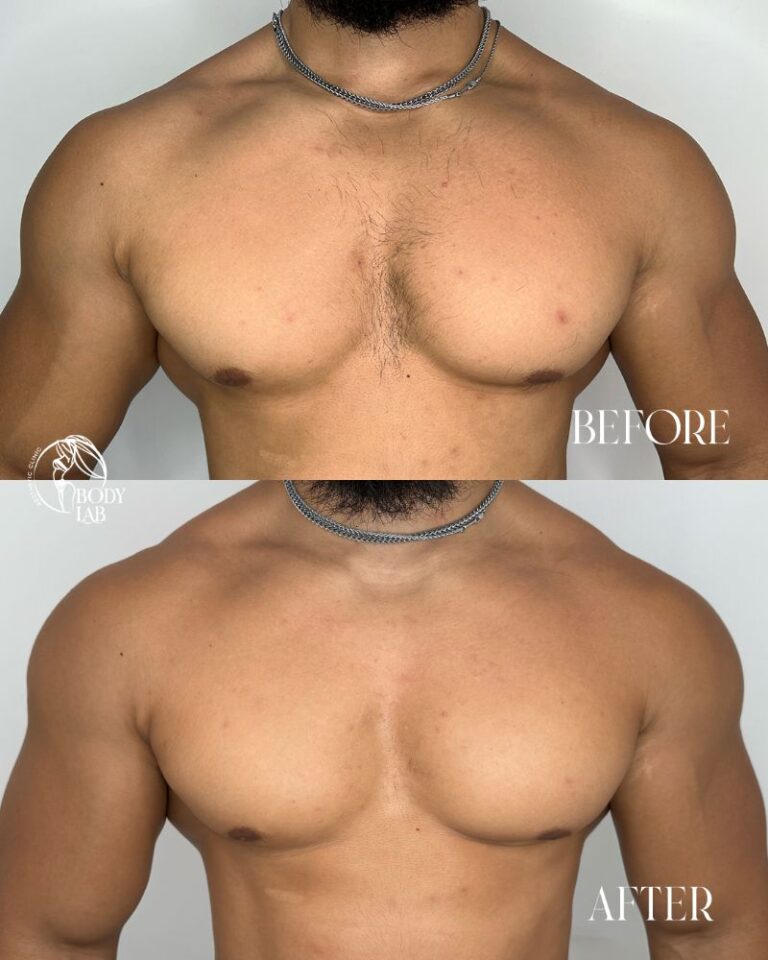 Laser Hair Removal