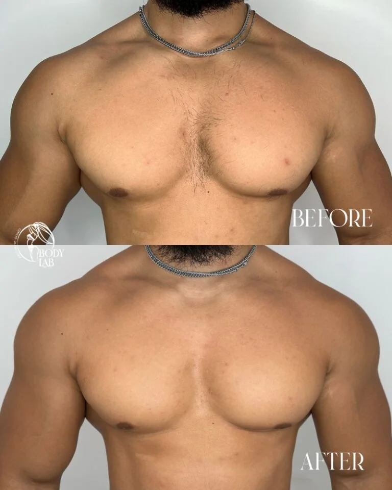 Laser Hair Removal