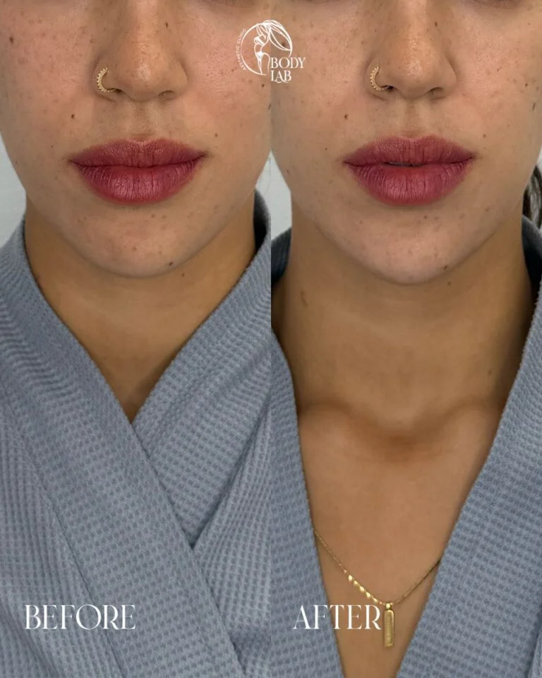 Chin Filler