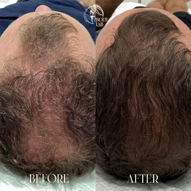 PRF + PRP (protocol with microneedling)