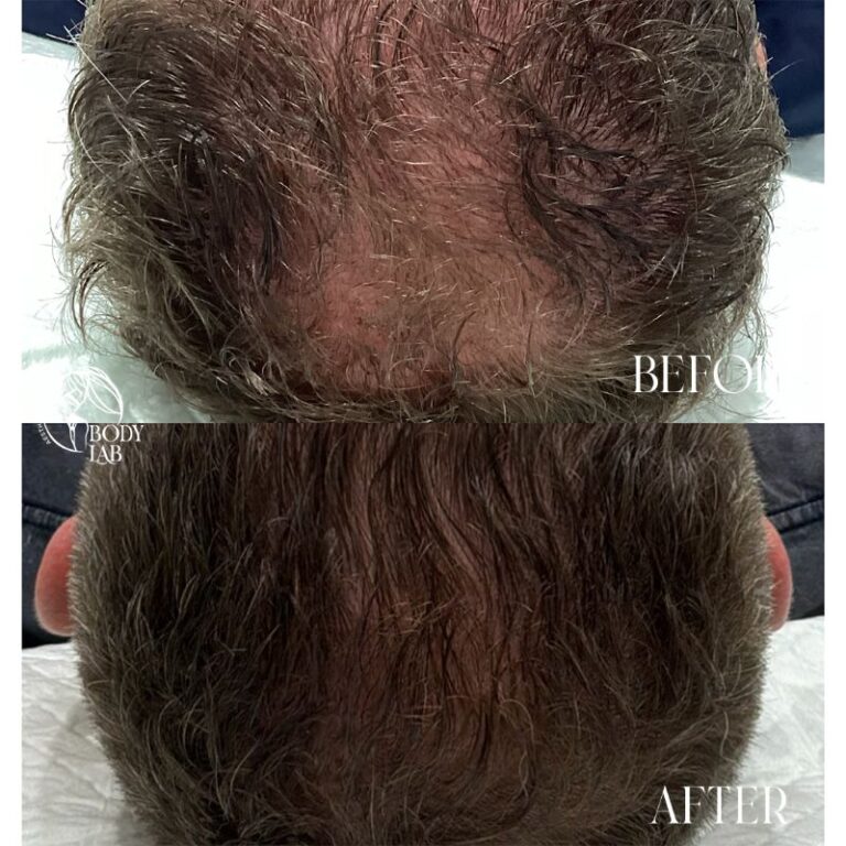 Microneedling